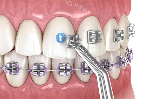 金属托槽矫正托槽粘贴