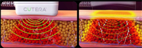 美国既塑3D溶脂操作过程