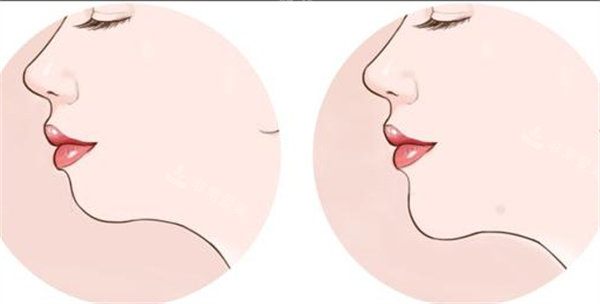 垫下巴前后对比图