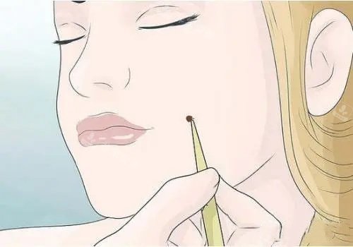 面部祛痣漫画示意图