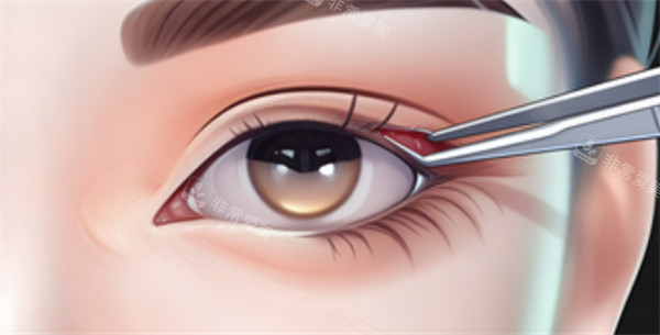 割双眼皮过程