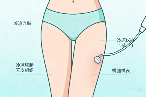 腿部做吸脂卡通图一览