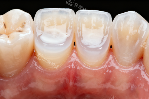 牙齿发黄图片展示