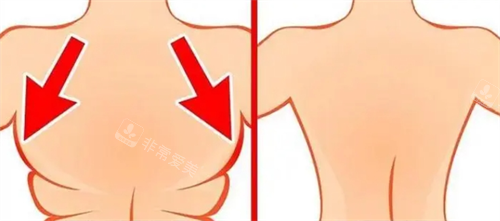背部吸脂前后动画对比图