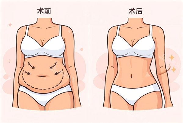 腰腹吸脂手术卡通图片前后对比