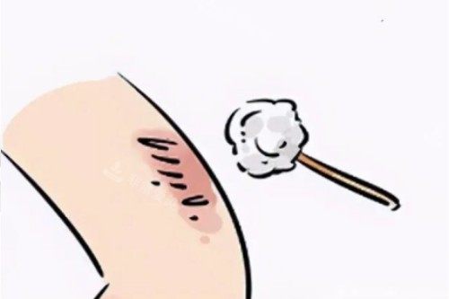 皮肤疤痕卡通图片展示