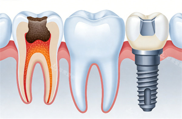 牙齿种植治疗卡通示意图