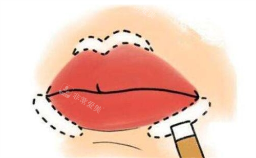 丰唇手术画线示意图