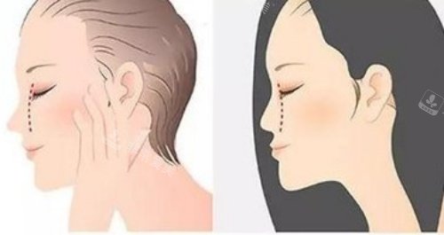 鼻基底凹陷漫画示意图