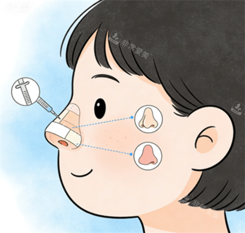 鼻修复的手术部位