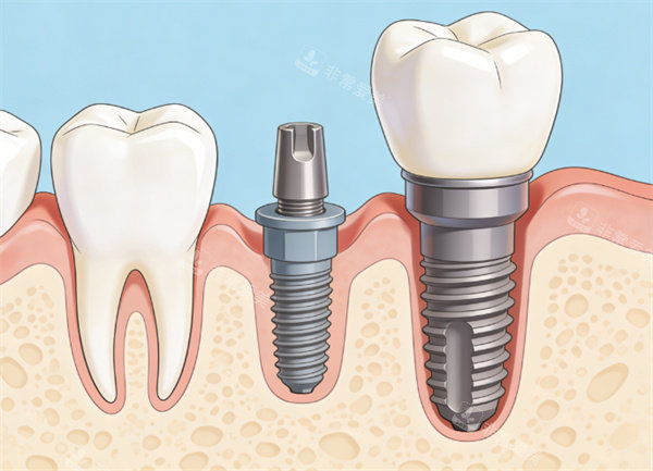 种植牙步骤卡通图片