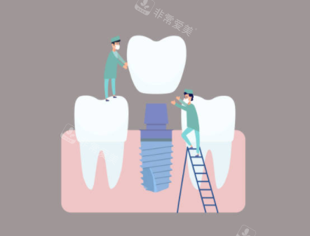 种植牙检查示意图