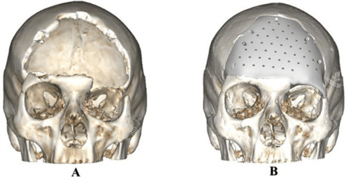 peek材料颅骨修补多少...