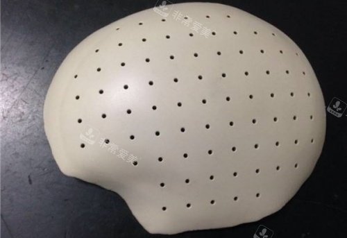 PEEK材料填充颅骨示意图