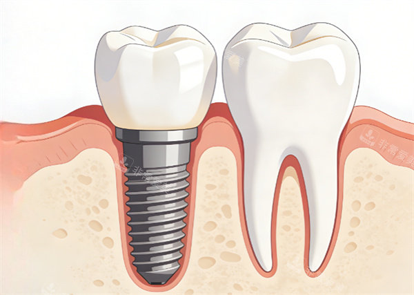 种植牙效果动画示意图