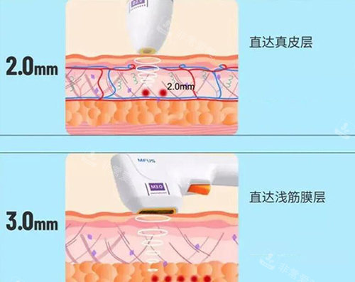 半岛超声炮探头展示图