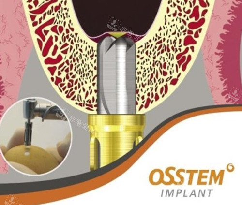 奥齿泰种植牙材料好不好