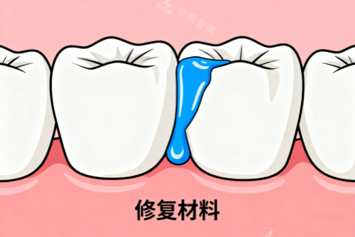 牙齿修复材料展示图