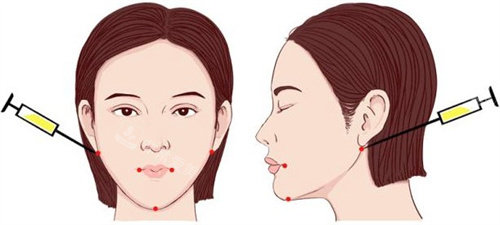 去韩国整形需要注意哪些坑？我的术后改善期如何熬过至暗时刻