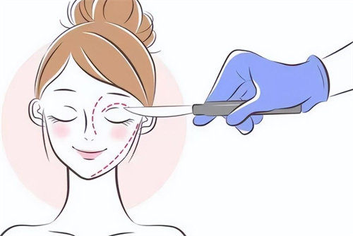 双眼皮手术设计 双眼皮手术设计