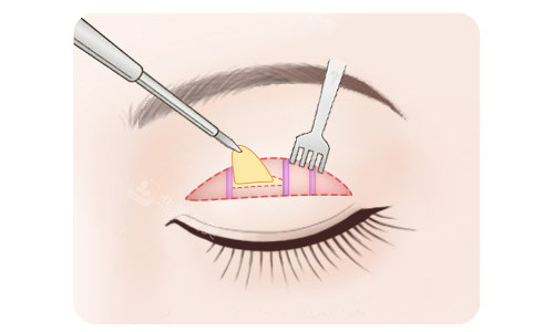 全切双眼皮脂肪切除 全切双眼皮脂肪切除