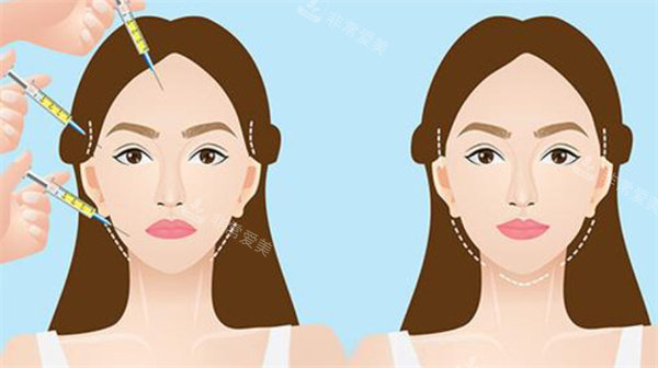 自体脂肪填充面部卡通图