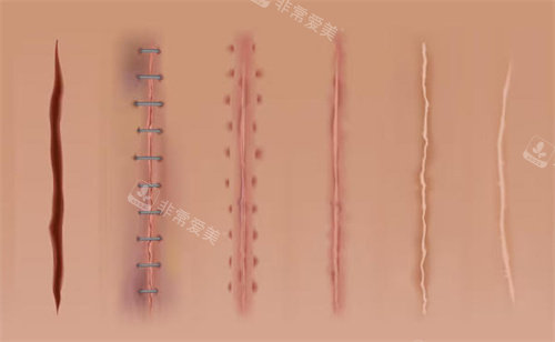 疤痕缝合修复过程