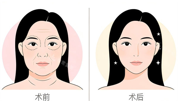 面部紧致提升手术前后对比