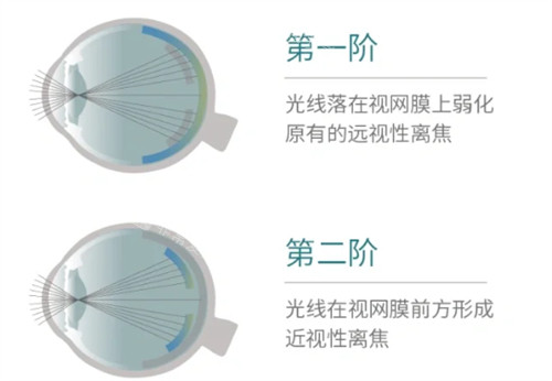 思问子夏离焦眼镜矫正过程