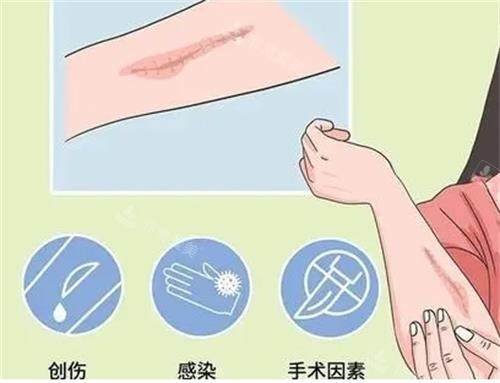 疤痕增生因素图