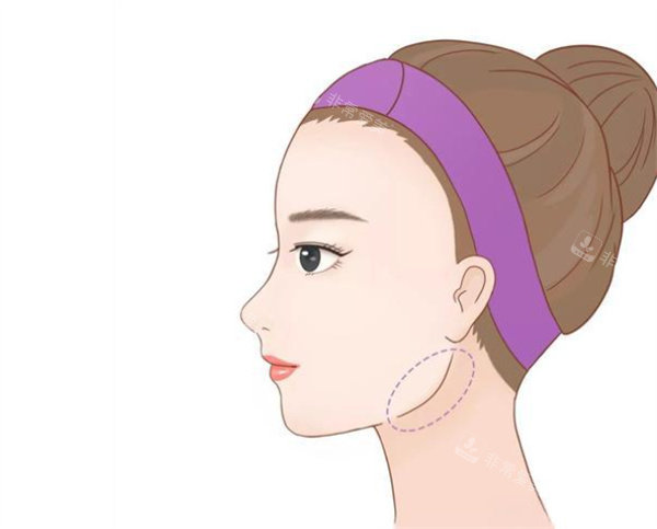 下颌角整形手术卡通图片