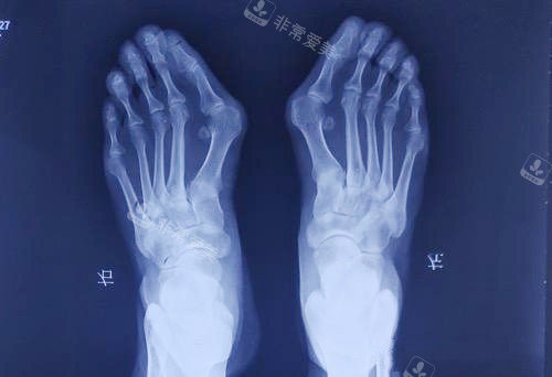 大脚骨拍片