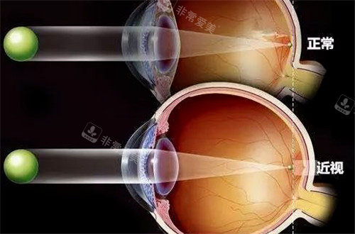 正常视力和近视视力表现图