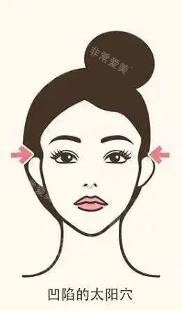 太阳穴凹陷整形手术 太阳穴凹陷整形手术