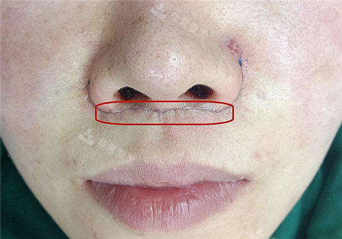 人中手術(shù)疤痕