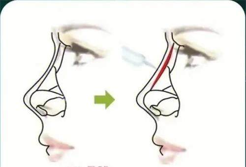 宝尼达玻尿酸注射隆鼻