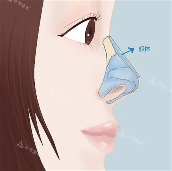 假体隆鼻整形手术
