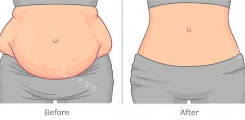 腹壁整形改善对比卡通图 腹壁整形改善对比卡通图
