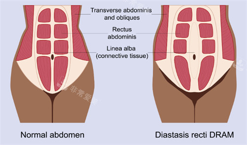 腹壁成形改善肌肉 腹壁成形改善肌肉