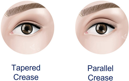 伍俊良双眼皮修复加眼...