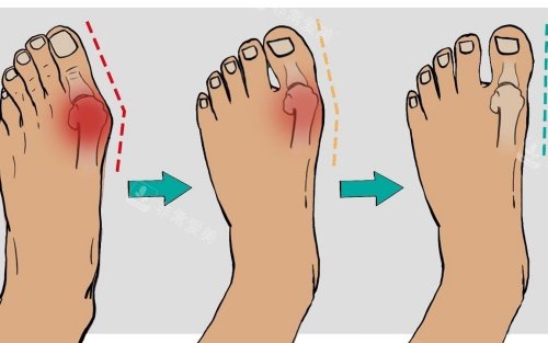 拇指外翻矫正示意图