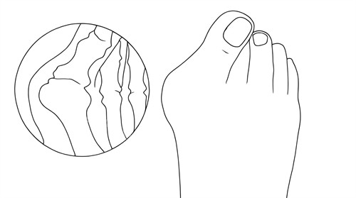 拇指外翻的样子