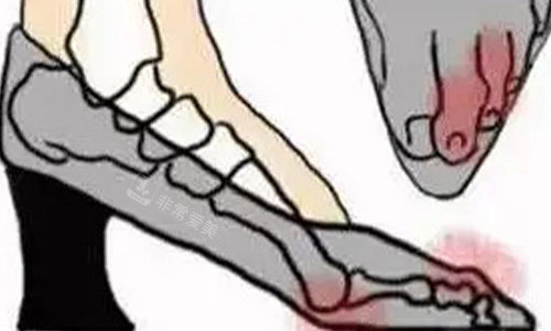 拇指外翻产生的影响