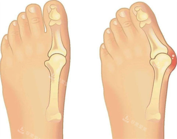 拇指外翻矫正手术