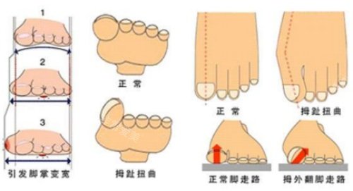 拇指外翻示意图