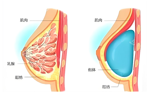隆胸假体放置位置 隆胸假体放置位置