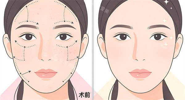 光子嫩肤术后前后对比