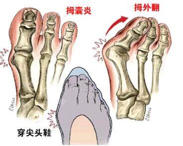 脚趾拇外翻卡通图照片