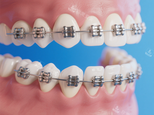 金属托槽牙齿矫正特写