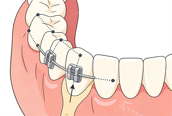 牙齿金属矫正操作图片